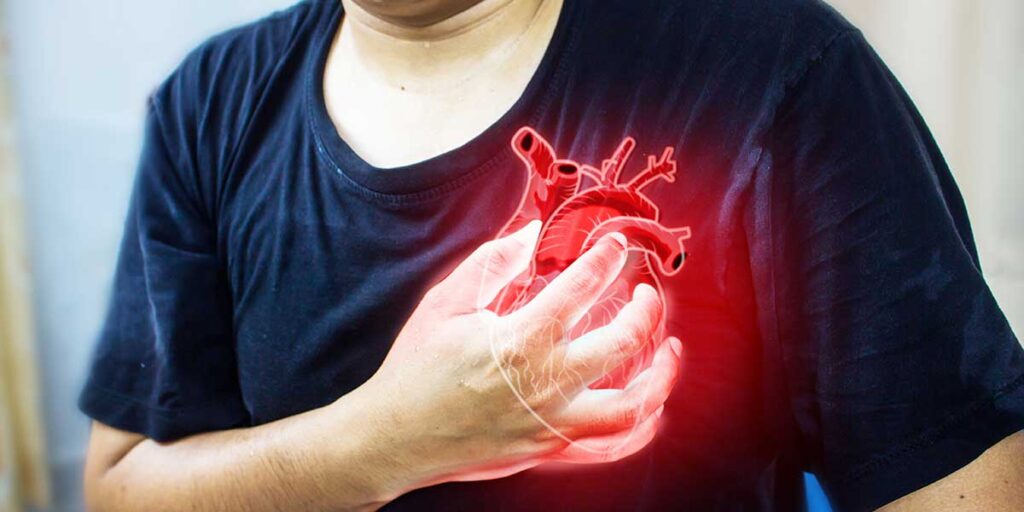 Critical Care Management of Myocardial Infarction (Heart Attack)